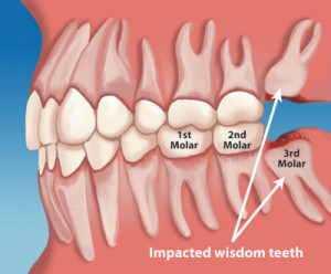 Impacted_Wisdom_Tooth