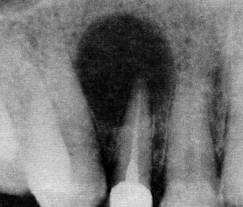 dental cyst