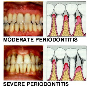 gumdisease2