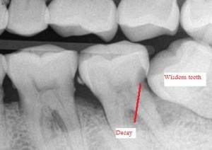 impacted wisdom tooth