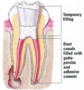 rootcanal2