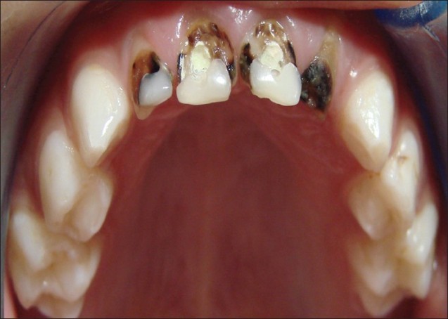 extractions
