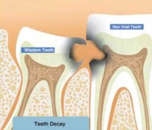 tooth_extraction